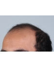 Before Hair Transplant&nbsp;Front